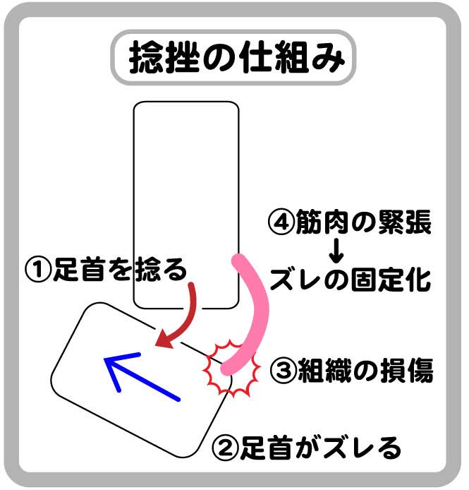 捻挫の仕組み