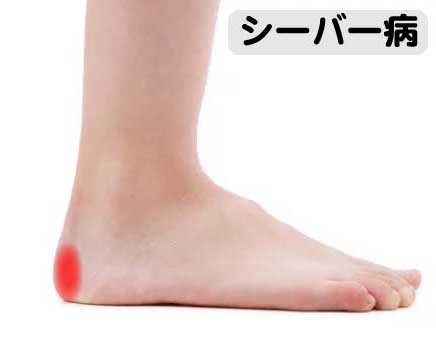 シーバー病