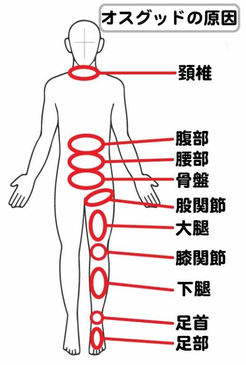 オスグッド原因図解