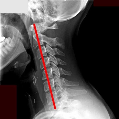 ストレートネック